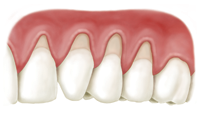 before AlloDerm root coverage