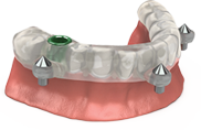 guided implant depth control