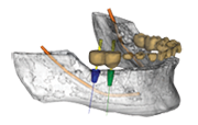 dental surgical guide