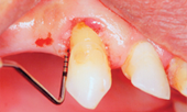 Dental Bone Graft - Grafton DBM