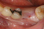 Internal dental implant