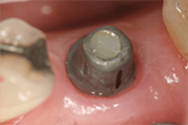 Internal dental implant