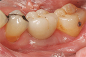 Internal dental implant