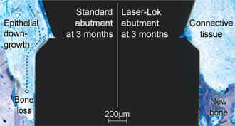 Laser-Lok
