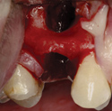 MinerOss Cortical & Cancellous