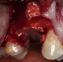 MinerOss Cortical & Cancellous