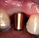 MinerOss Cortical & Cancellous