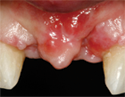 maxillary defect