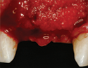 MinerOss Cancellous Graft