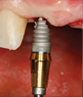 dental implant placement