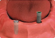 dental implant placement - dental implant-stabilized overdenture