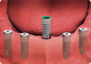 dental implant placement - removable dental implant-supported overdenture