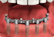 custom overdenture created - removable dental implant-supported overdenture