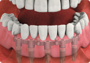 attach custom overdenture - removable dental implant-supported overdenture