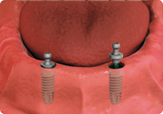 overdenture fitting - dental implant-stabilized overdenture