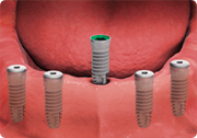 dental implant placement - fixed dental implant-supported overdenture