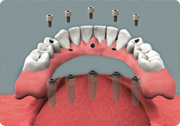 dental implant placement - fixed dental implant-supported overdenture