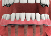 make custom overdenture - fixed dental implant-supported overdenture