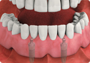 overdenture attached - dental implant-stabilized overdenture