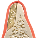 dental bone grafting