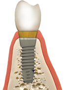 dental bone grafting