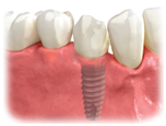 dental implant crown