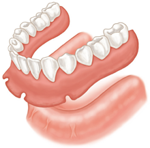 implant supported denture vs traditional denture