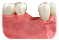 untreated missing tooth