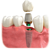 dental implant with a crown