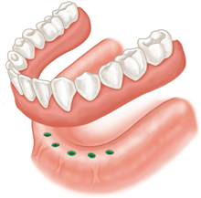 implant supported dentures