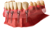 overdentures