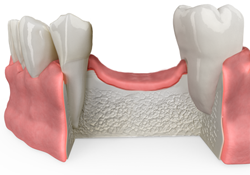 dental bone grafting