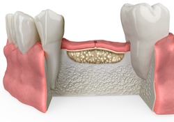 dental bone grafting