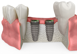 dental bone grafting