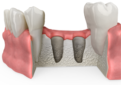 dental bone grafting