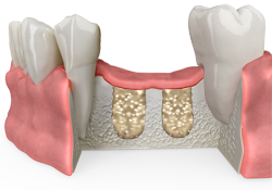 dental bone grafting