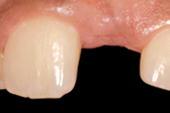 Tapered Internal dental implant