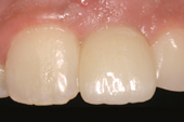 Tapered Internal dental implant