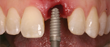 Tapered Plus Dental Implants maintain crestal bone